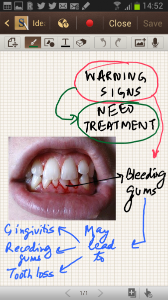 The doctor then went on to emphasise his logic with an illustrated example of the sort of warning bleeding gums give!